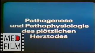 Herztodes: Pathogenese und Pathophysiologie © Патогенез и патофизиология сердечной смерти