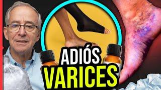  ADIÓS A LAS VARICES - Oswaldo Restrepo RSC