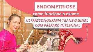 MAPEAMENTO DE ENDOMETRIOSE | Como funciona a Ultrassonografia Transvaginal com Preparo Intestinal