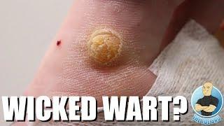 CRAZY PUFFY PLANTAR WART REMOVAL