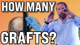 How many Grafts will you need for a Hair Transplant!?