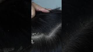 dandruff scratching addiction #58