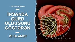 İnsanda qurd olduğunu göstərən 20 əlamət- Dəhşətli fəsadlar