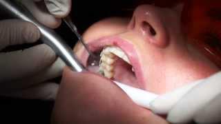 Simply Teeth - Fitting a Fastbraces® system
