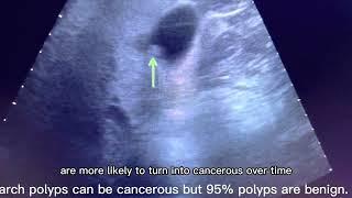 Ultrasound Shows GallBladder Polyps #gallbladder  #gallbladderpolyps #ultrasound #ultrasoundscans