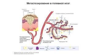 Метастатическое поражение головного мозга при меланоме. Как выбрать правильный алгоритм лечения?