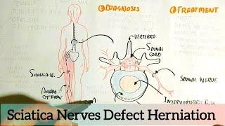 Sciatica, Herniated Disc All You Need To know!