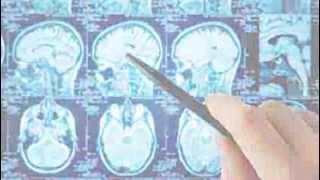 'Good brain, bad brain: Parkinson's disease' - free online course on FutureLearn.com