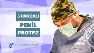 3 Parçalı Penil Protez (Mutluluk Çubuğu) Nedir? Dr. Yaşar Başağa, MD, FEBU