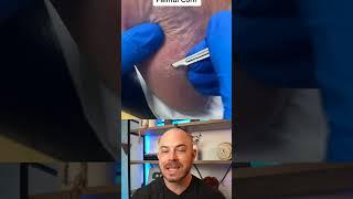 Doctor reacts to corn callus removal! #footcorn #dermreacts #doctorreacts
