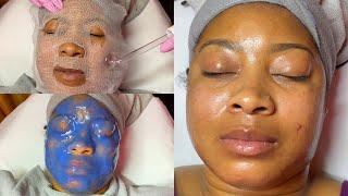 Severe Acne & Hyperpigmentation Facial Treatment | LiaLeigh