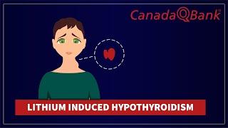 Lithium-Induced Hypothyroidism: Side Effects, Symptoms & Clinical Vignettes | CanadaQBank