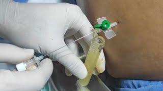 Remove abdominal fluid (ascites) | Paracentesis | Ascitic fluid aspiration