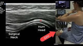 Ultrasound Shoulder - tips for successful rotator cuff and inferior glenohumeral ligament imaging.