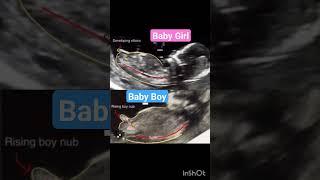 nub theory Gender Reveal ultrasound scan #nubtheory #genderpredictions