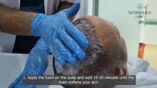 How to remove scabs after 10 days hair transplant | Hair Transplant Turkey