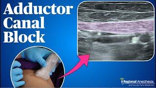 Adductor Canal Block (2024 update!)