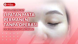 CARA MEMBUAT LIPATAN MATA PERMANEN TANPA OPERASI DI KLINIK KECANTIKAN!