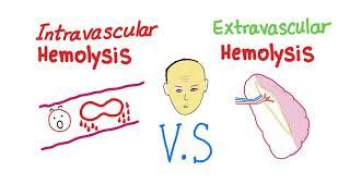 Intravascular Vs Extravascular Hemolytic Anemia; What's The ACTUAL Difference?