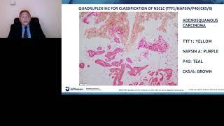 Chromogenic multiplex IHC; the future of immunohistochemistry for the practicing pathologist ...