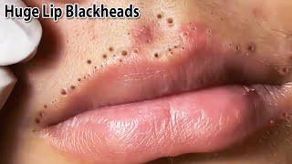 Removes a lot of blackheads on upper and lower lips | Satisfaction and Relaxation Videos 2024 | Tips