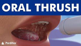 ORAL THRUSH - Candidiasis or yeast infection. Angular cheilitis ©