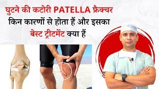 Knee cap ya patella fracture me ilaz kaise kare / patella ftacture me knee stiff ho jaye to kya ka