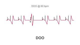 Asynchronous Pacing Modes: Preparing for Surgical Scenarios