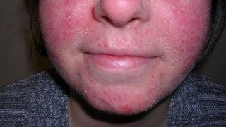How to Treat Facial Eczema [DermTV.com Epi #479]