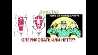 Диастаз прямых мышц живота: нужно ли оперировать? Виды операций.