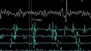 Reducing Noise Levels in Electrophysiology Medical Procedures