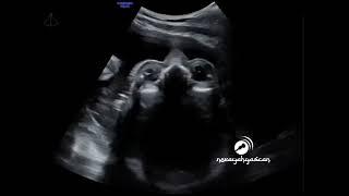 Fetal orbital, lense and palate