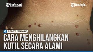 CARA ALAMI UNTUK MENGHILANGKAN KUTIL YANG MEMBANDEL