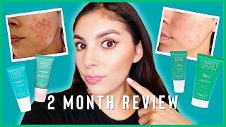 I am surprised... | Selfless by Hyram Review on ACNE PRONE SKIN Full 2 Month Review