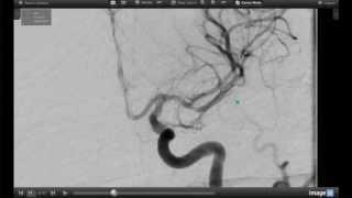 How Endovascular Stroke Treatment Works