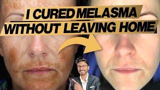Melasma Treatment At Home: Expert Doctor's 3 Easy Steps (+ before and after)