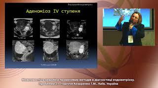 Можливості та недоліки променевих методів в діагностиці ендометріозу  Проблеми 21 сторіччя