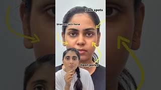 Skin treatment for glowing skin | Face lightening treatment | Laser skin whitening treatment
