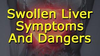 Swollen Liver Symptoms And Dangers