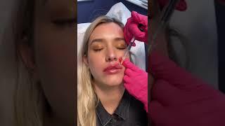 LIP FILLER: PICKET FENCE TECHNIQUE 