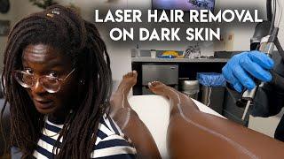 My Laser Hair Removal Experience as a Dark Skin Woman // LaserAway