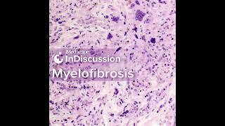 Risk Stratification in Myelofibrosis: Which Model Should You Use?