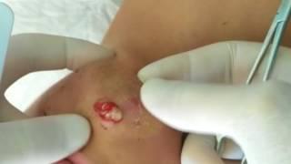 Squeezing big pimple on the face,Popping Boil/.Выдавливание прыща на лице.