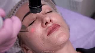 4D омоложение лица на лазере Fotona |ТОП-5 вопросов о процедуре | Клиника Vidnova