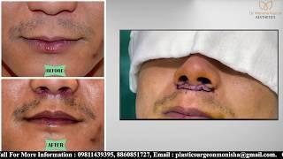 Patient Review | Lip Lift Surgery in Delhi | Performed by Dr Monisha Kapoor