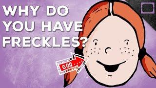 Why Do You Have Freckles?