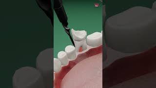 Learn 'How is a Broken teeth fixed' in a minute