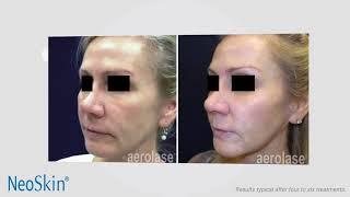 NeoSkin by Aerolase. Comprehensive Rejuvenation for All Ages and Skin Tones