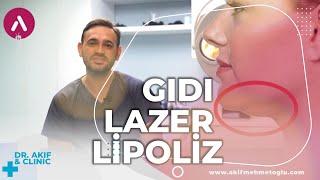 Gıdı Lazer Lipoliz Hakkında merak edilenler - UZM. DR. AKİF MEHMETOĞLU