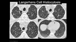 Patterns of Lung Disease in CT Scan